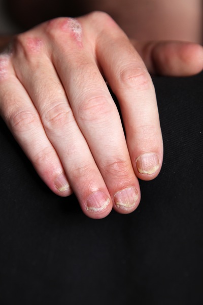 Nail Psoriasis May Include Loose and Deformed Nails, But is Treatable
